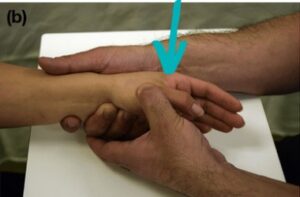Diagnóstico Diferencial del Dolor Radial de Muñeca - ReHand ...
