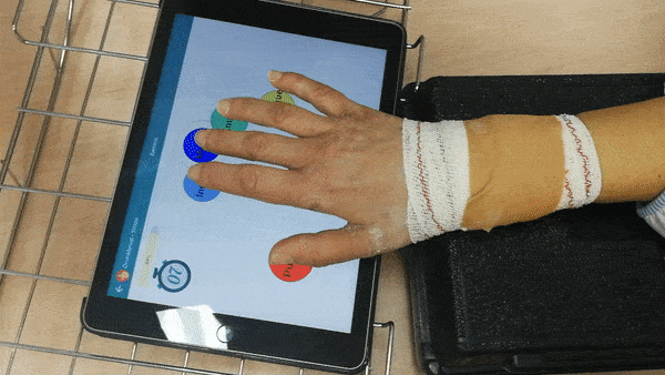 Ejercicio de Movilidad Temprana en Fractura de Escafoides Ejercicio de Movilidad Temprana en Fractura de Escafoides